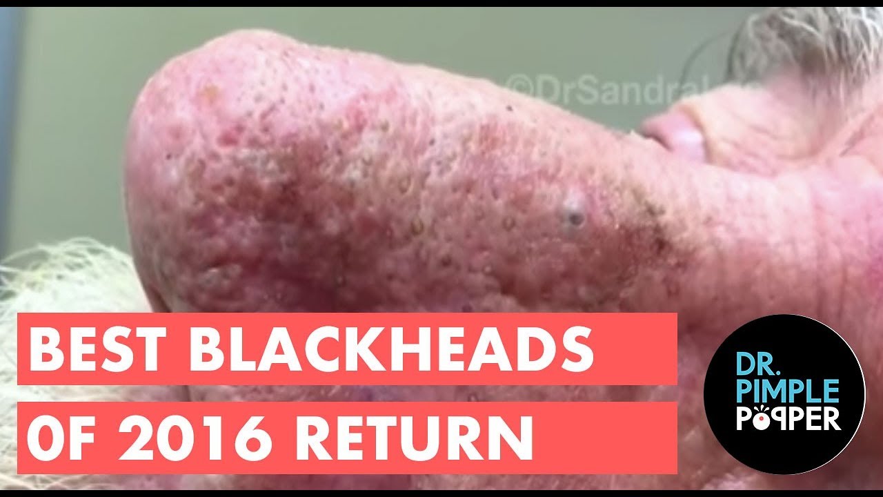 Youtube Pimple Popper