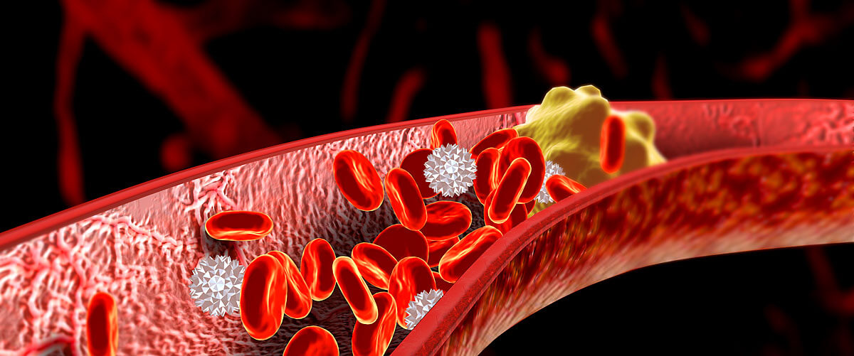 Thrombose Symptome